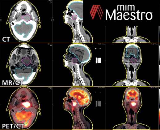 治療計画支援装置：MIM Maestro