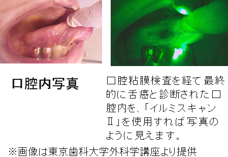 医師が口腔がんの生検を推奨するのはどのような場合ですか?