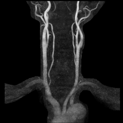 頚部MRA画像