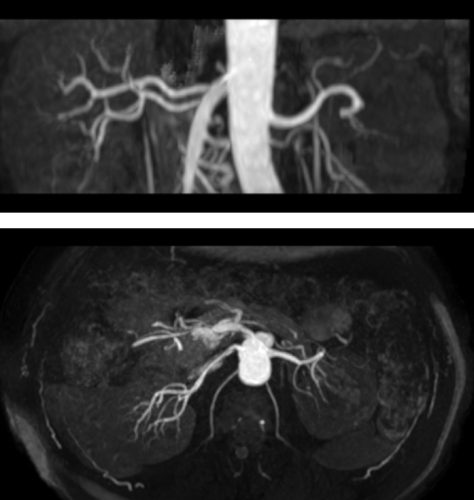 腎動脈MRA画像