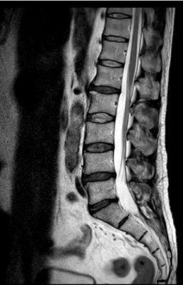 腰椎MRI画像
