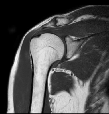肩関節MRI画像