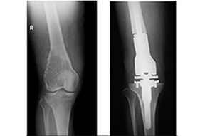 腫瘍用人工関節を用いた患肢温存手術<br/>（悪性骨腫瘍）