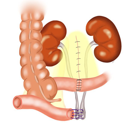 回腸導管の術式イラスト