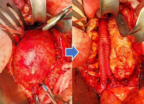 腹部大動脈瘤に対する開腹人工血管置換術