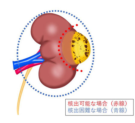 腫瘍摘除のイメージ