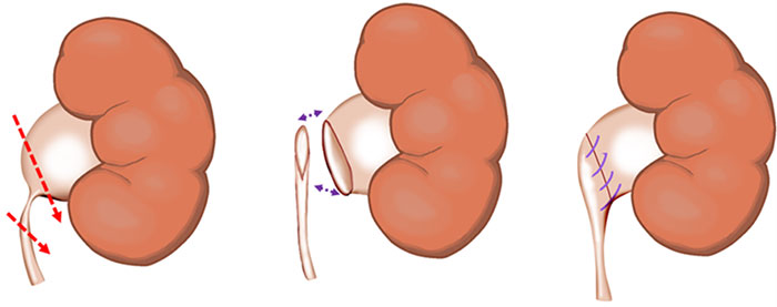 手術内容の術式イラスト