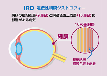 遺伝子を補充する最先端治療で暗闇に光を