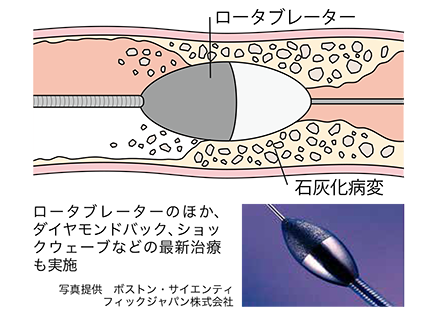 「心不全パンデミック」を防ぐ最新治療