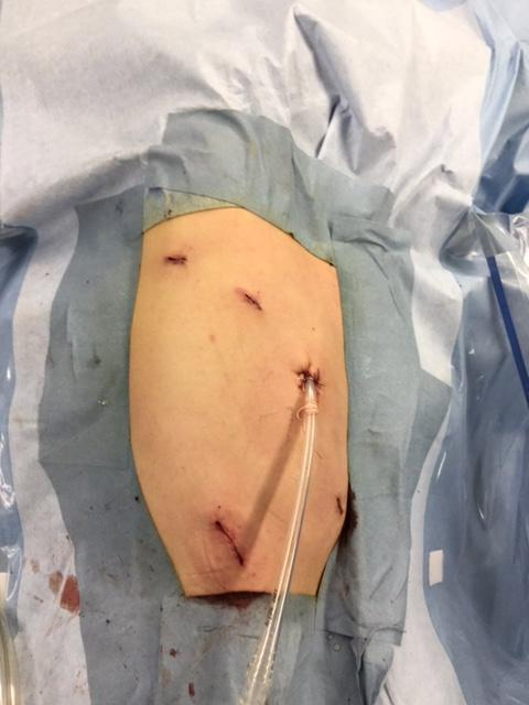 術後の状態、③のポート孔よりドレーンを留置しています