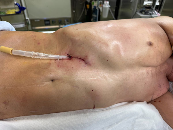 術後の状態、創部よりドレーンを留置しています