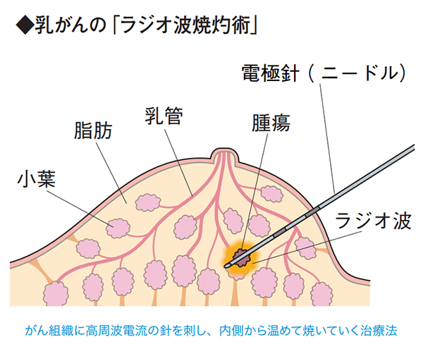 乳がんの「ラジオ波焼灼術」