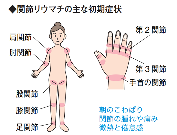 痛みや腫れを改善 進化する関節リウマチ治療
