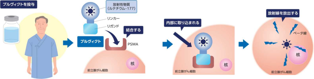 プルヴィクト治療のしくみ