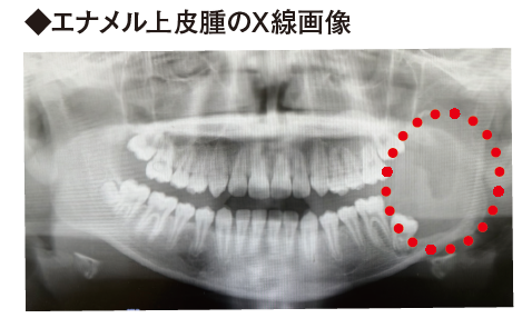 エナメル上皮腫のX線画像