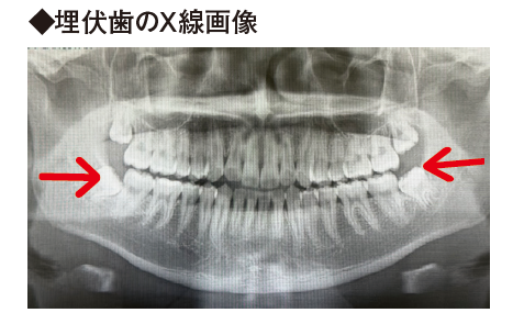 埋伏歯のX線画像