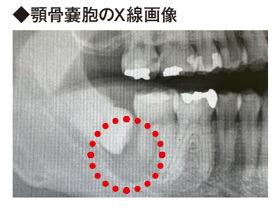 顎骨嚢胞のX線画像