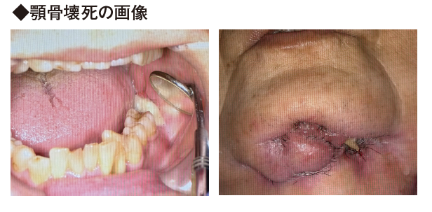 口腔がんの好発部位