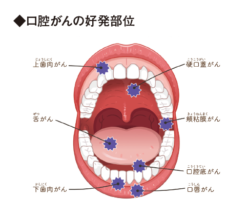 口腔がんの好発部位